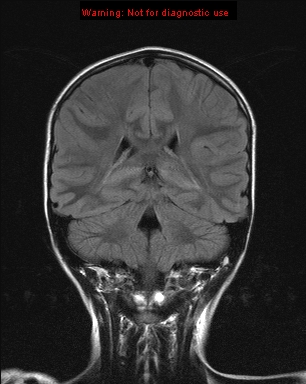 File:Neurofibromatosis type 1 with optic nerve glioma (Radiopaedia 16288-15965 Coronal FLAIR 9).jpg