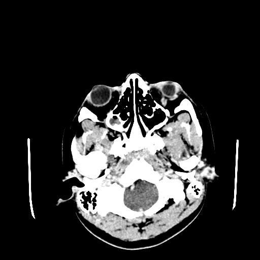 File:Neurofibromatosis type 2 (Radiopaedia 25389-25637 Axial C+ 7).jpg