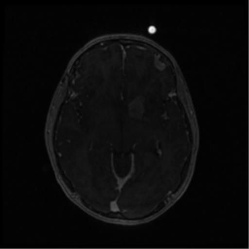 Neurofibromatosis type 2 (Radiopaedia 45229-49244 Axial T1 C+ 59).png