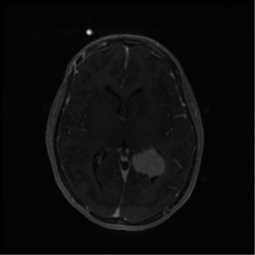 Neurofibromatosis type 2 (Radiopaedia 45229-49244 Axial T1 C+ 65).png