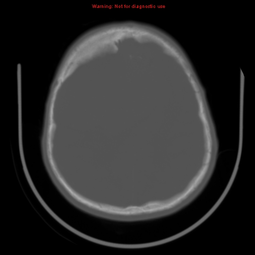 File:Neurofibromatosis type 2 (Radiopaedia 8953-9732 Axial bone window 25).jpg