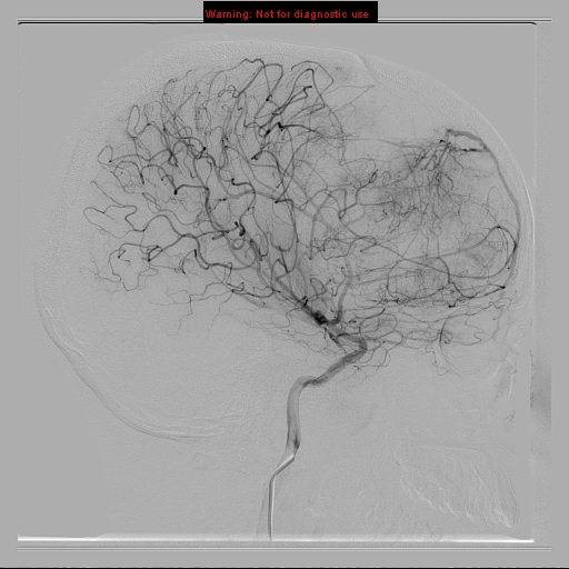 File:Neurofibromatosis type 2 (Radiopaedia 8953-9733 C 8).jpg