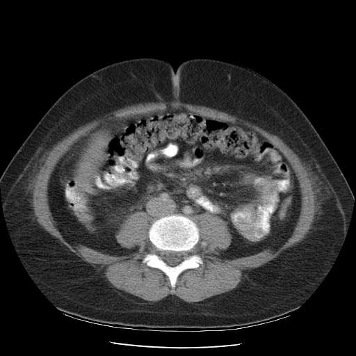File:Non-Hodgkin lymphoma involving pelvis (Radiopaedia 21281-21197 A 39).jpg
