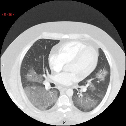 File:Non-specific interstitial pneumonitis (Radiopaedia 27044-27222 Axial lung window 27).jpg