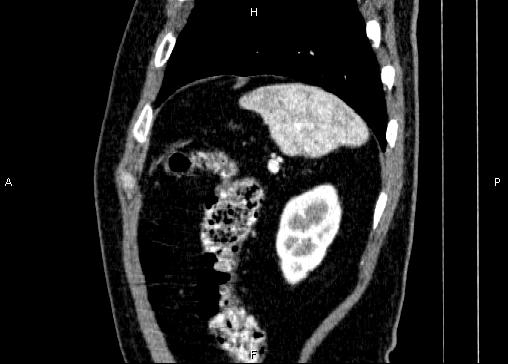 Non-syndromic pancreatic endocrine tumor (Radiopaedia 86958-103178 E 87).jpg