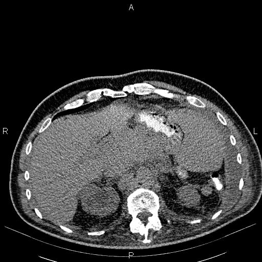 File:Non Hodgkin lymphoma in a patient with ankylosing spondylitis (Radiopaedia 84323-99621 Axial non-contrast 29).jpg