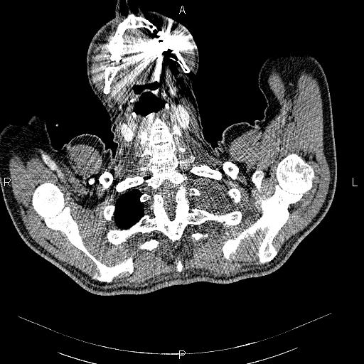 File:Non Hodgkin lymphoma in a patient with ankylosing spondylitis (Radiopaedia 84323-99621 B 3).jpg