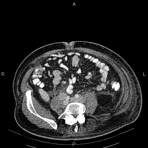 File:Non Hodgkin lymphoma in a patient with ankylosing spondylitis (Radiopaedia 84323-99621 B 48).jpg