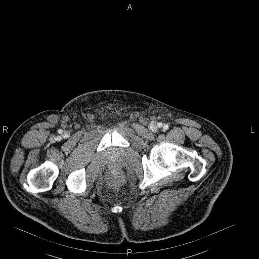 File:Non Hodgkin lymphoma in a patient with ankylosing spondylitis (Radiopaedia 84323-99621 B 65).jpg