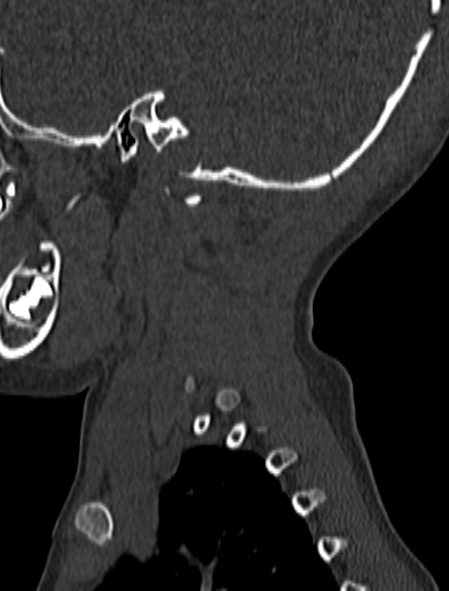 File:Normal CT cervical spine - pediatric (Radiopaedia 52549-58462 Sagittal bone window 3).jpg