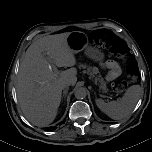 File:Normal CT intravenous cholangiogram (Radiopaedia 38199-40208 Axial IVC 26).png
