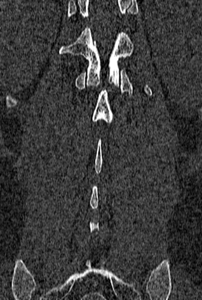 Normal CT lumbar spine (Radiopaedia 53981-60118 Coronal bone window 58).jpg