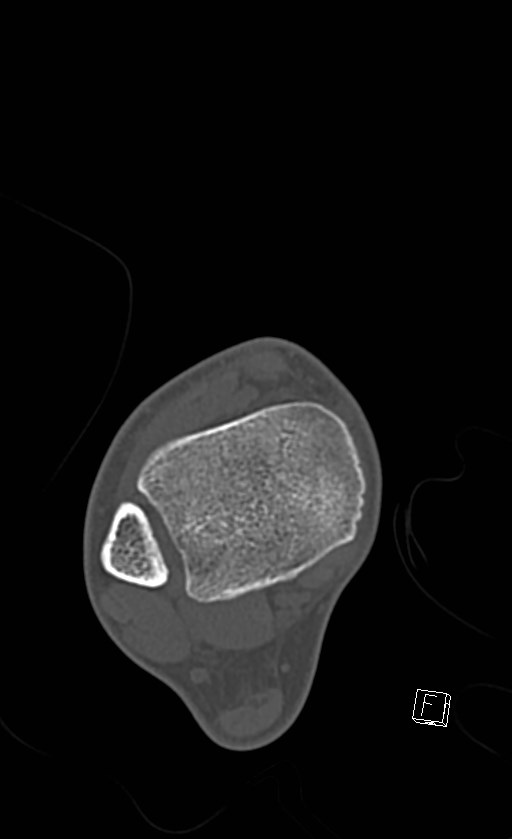 Normal CT of the ankle (Radiopaedia 47111-51658 Axial bone window 29).jpg
