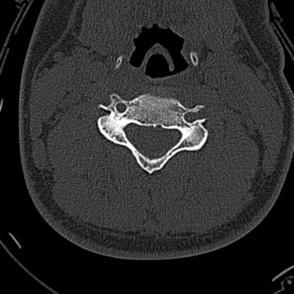 Normal CT of the cervical spine (Radiopaedia 53322-59305 Axial bone window 133).jpg