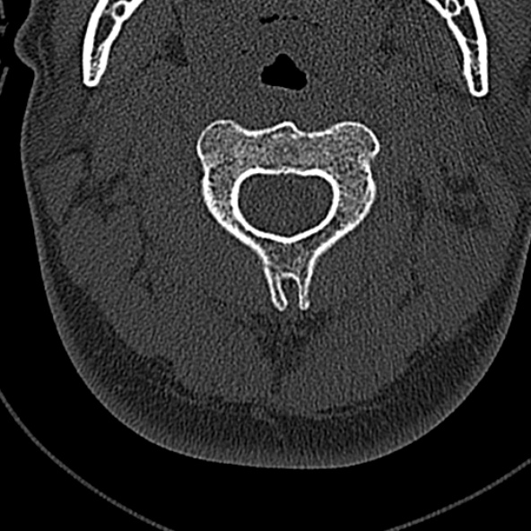 Normal CT of the cervical spine (Radiopaedia 53322-59305 Axial bone window 82).jpg