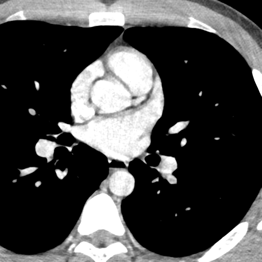 File:Normal CT pulmonary veins (pre RF ablation) (Radiopaedia 41748-44702 A 123).png