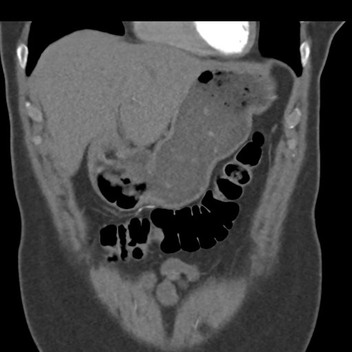 File:Normal CT renal artery angiogram (Radiopaedia 38727-40889 B 19).png