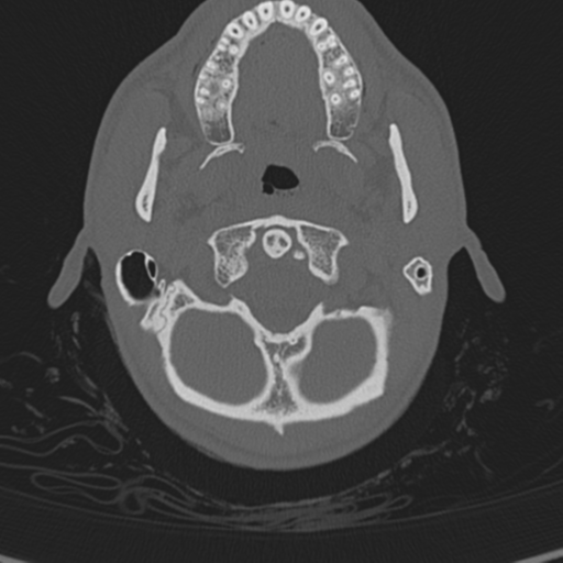 Normal CT skull (Radiopaedia 40798-43459 A 11).png