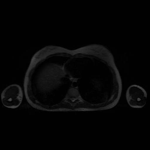 File:Normal MRI abdomen in pregnancy (Radiopaedia 88001-104541 Axial T2 3).jpg
