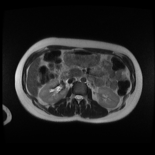 Normal MRI abdomen in pregnancy (Radiopaedia 88003-104546 Axial T2 11).jpg