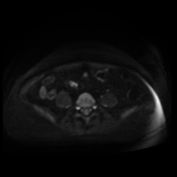 Normal MRI abdomen in pregnancy (Radiopaedia 88005-104548 Axial DWI 68).jpg