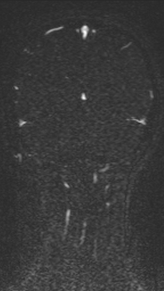 Normal MRI brain with MRV- teenager (Radiopaedia 49425-54553 Coronal MRV 188).jpg
