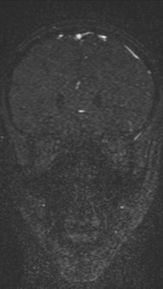 Normal MRI brain with MRV- teenager (Radiopaedia 49425-54553 Coronal MRV 84).jpg