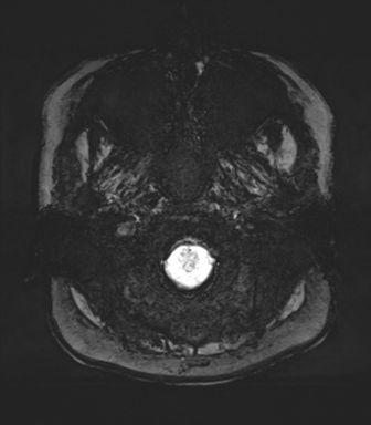 Normal MRI internal auditory canal (Radiopaedia 41613-44525 Axial SWI MIP 2).png