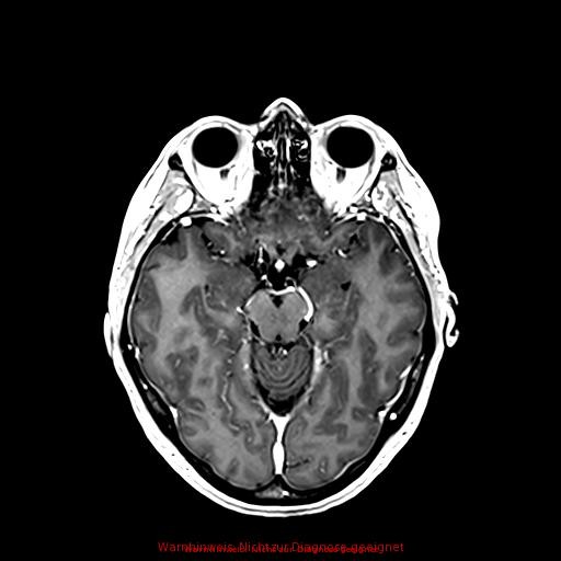 Normal adult brain MRI (non-enhanced and contrast-enhanced) (Radiopaedia 75262-86379 Axial T1 C+ 88).jpg