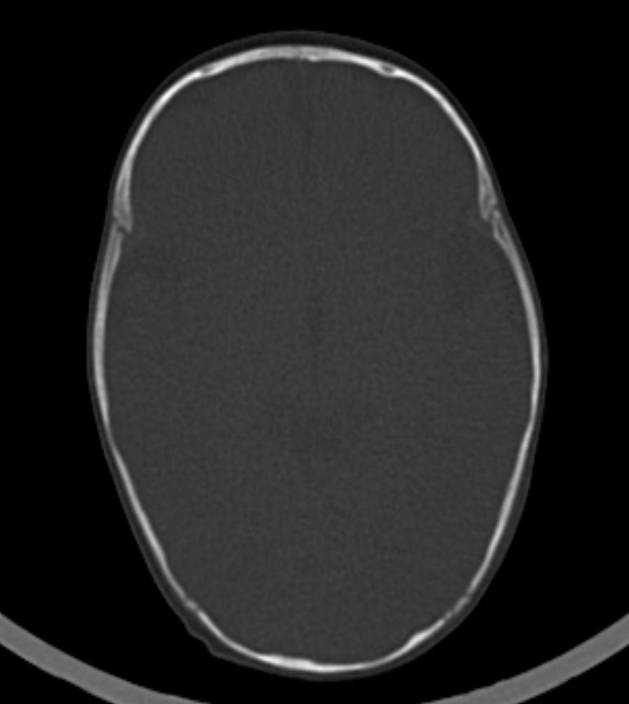 Normal brain CT - 2-month-old (Radiopaedia 53369-59350 Axial bone window 34).jpg