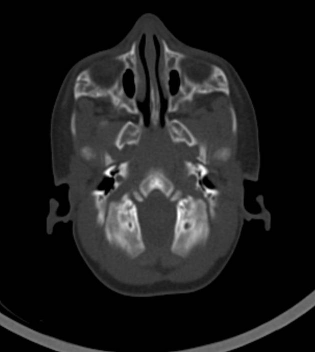 Normal brain CT - 2-month-old (Radiopaedia 53369-59350 Axial bone window 53).jpg