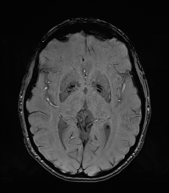 Normal brain MRI (TLE protocol) (Radiopaedia 40748-43405 Axial SWI 43).png