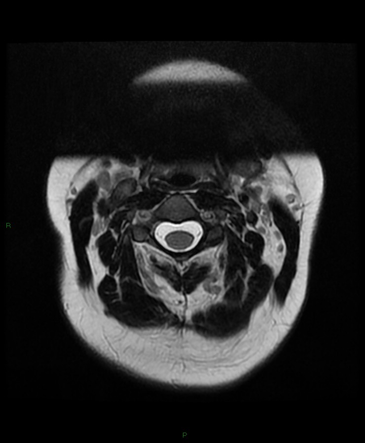 Normal cervical spine MRI (Radiopaedia 80146-93454 Axial T2 20).jpg