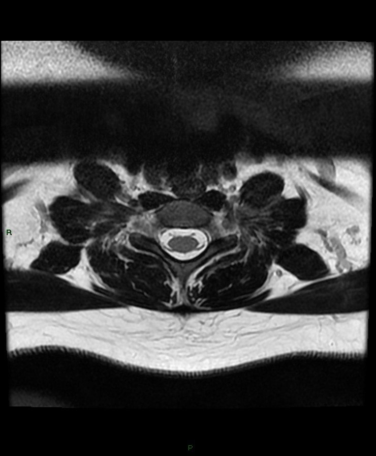 Normal cervical spine MRI (Radiopaedia 80146-93454 Axial T2 83).jpg