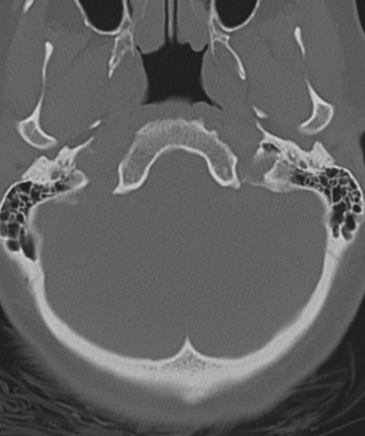 Normal cervical spine MRI (including Dixon) (Radiopaedia 42762-45926 Axial bone window 4).png