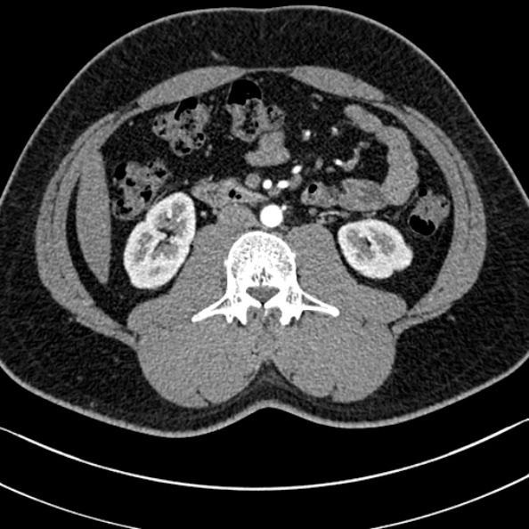 Normal kidneys on 4-phase CT study (Radiopaedia 25889-26038 B 60).jpg