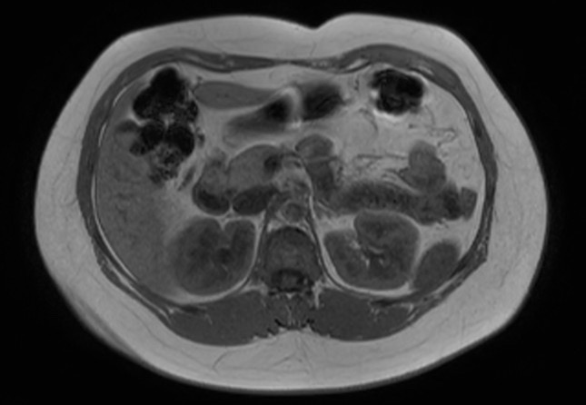 File:Normal liver MRI with Gadolinium (Radiopaedia 58913-66163 Axial T1 in-phase 17).jpg
