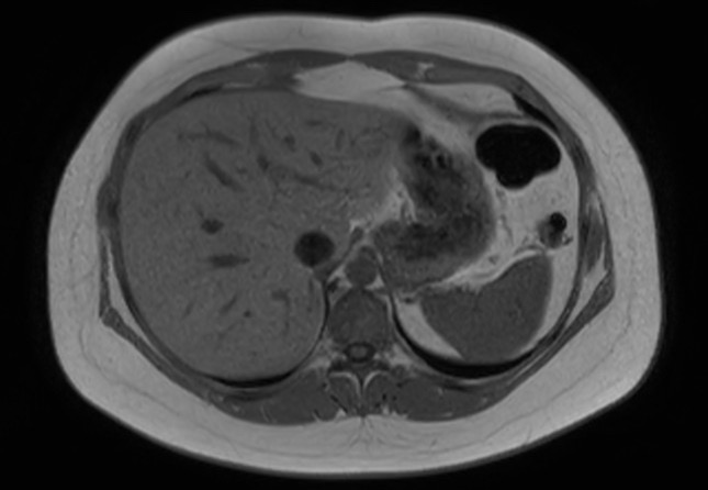 File:Normal liver MRI with Gadolinium (Radiopaedia 58913-66163 Axial T1 in-phase 24).jpg