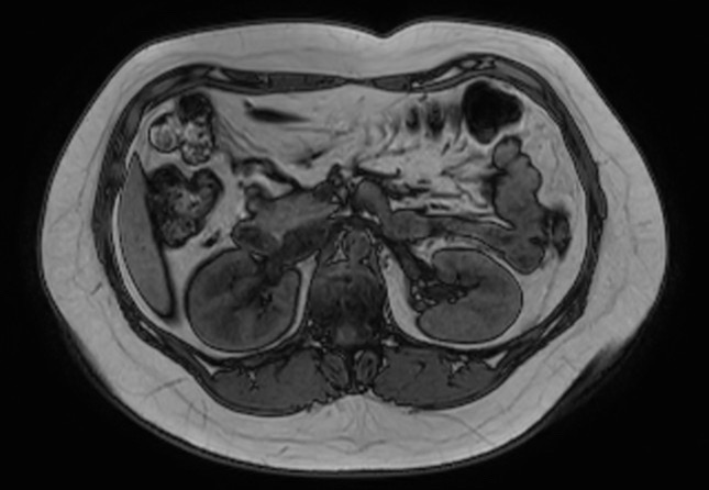 File:Normal liver MRI with Gadolinium (Radiopaedia 58913-66163 B 15).jpg