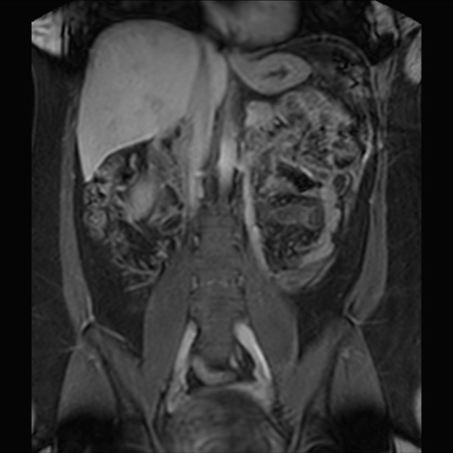 Normal liver MRI with Gadolinium (Radiopaedia 58913-66163 P 47).jpg