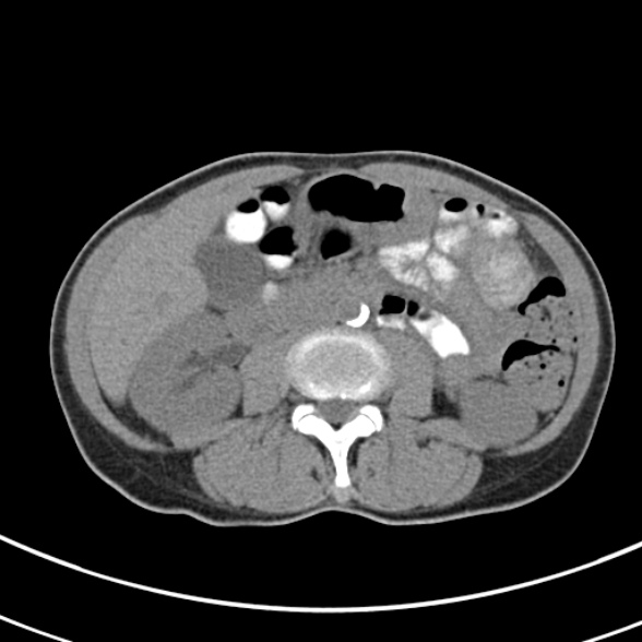 File:Normal multiphase CT liver (Radiopaedia 38026-39996 Axial non-contrast 40).jpg