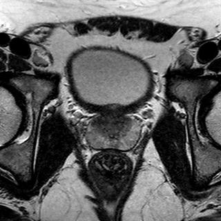 File:Normal prostate (MRI) (Radiopaedia 29986-30535 Axial T2 12).jpg