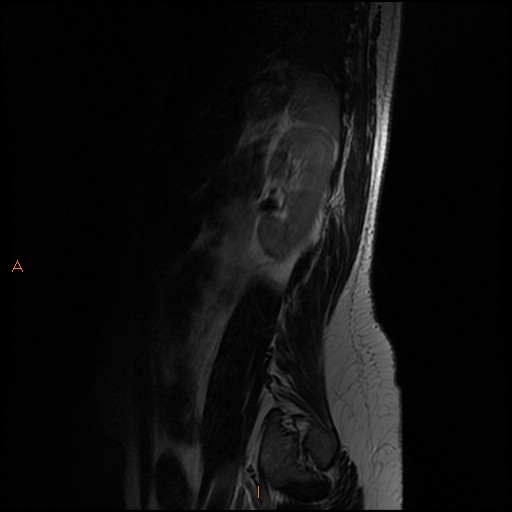 File:Normal spine MRI (Radiopaedia 77323-89408 Sagittal T2 15).jpg