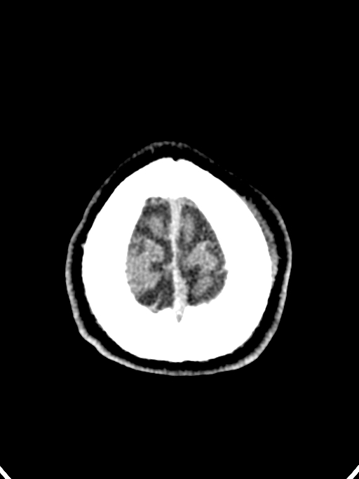 Normal trauma protocol brain and C-spine CT (Radiopaedia 83302-97709 Axial non-contrast 11).jpg