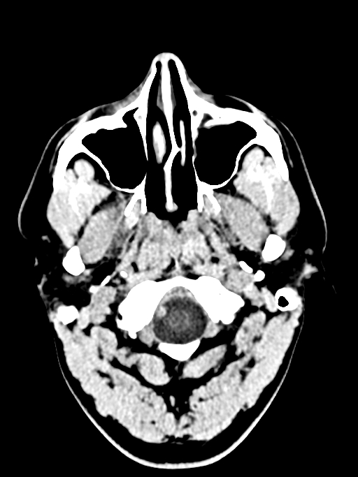 Normal trauma protocol brain and C-spine CT (Radiopaedia 83302-97709 Axial non-contrast 66).jpg
