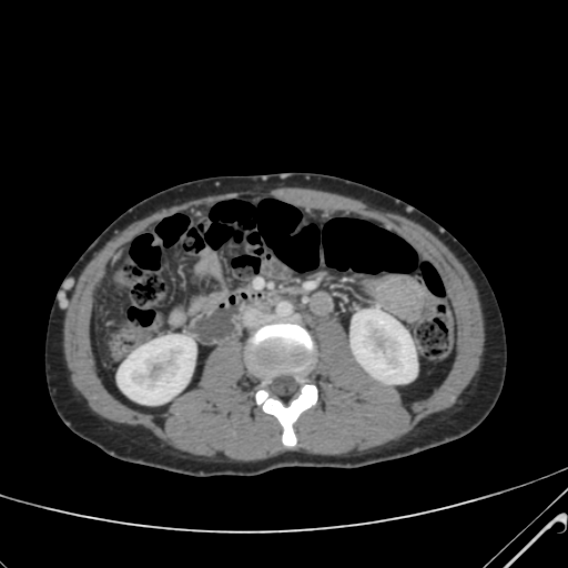 File:Nutmeg liver- Budd-Chiari syndrome (Radiopaedia 46234-50635 B 33).png