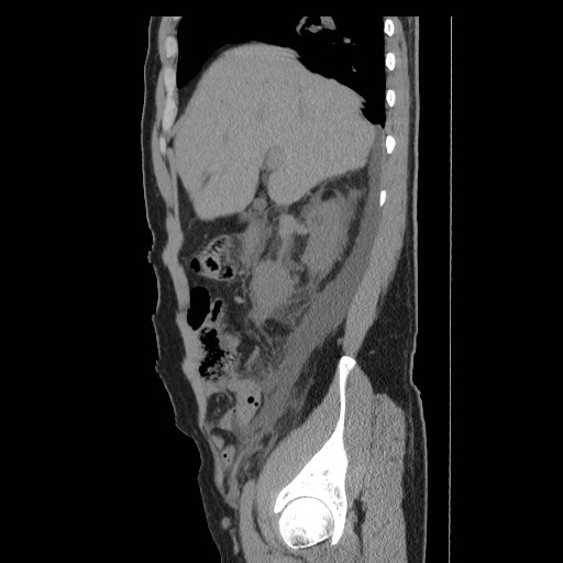 File:Obstructed kidney with perinephric urinoma (Radiopaedia 26889-27066 B 12).jpg