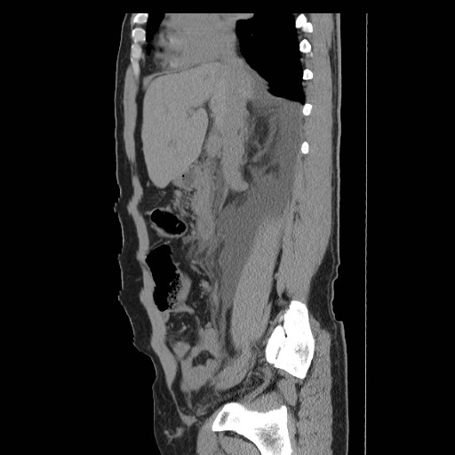 File:Obstructed kidney with perinephric urinoma (Radiopaedia 26889-27066 B 21).jpg