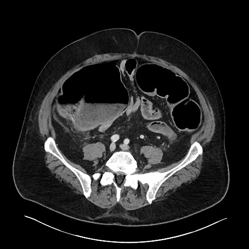 Obstructing sigmoid adenocarcinoma (Radiopaedia 58465-65619 A 113).jpg