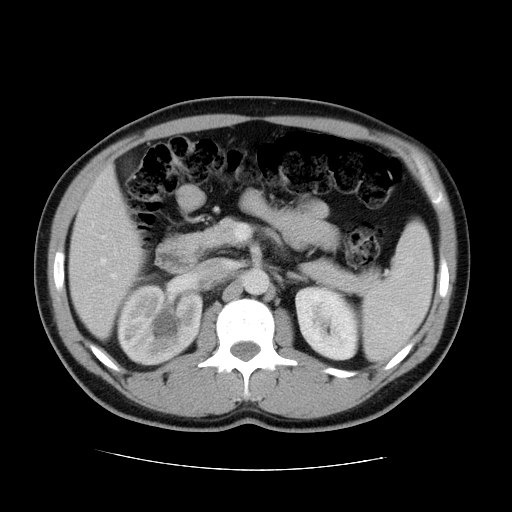 File:Obstructing ureteric calculus (Radiopaedia 18615-18514 B 20).jpg